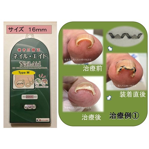 楽天市場】巻き爪 矯正 自分で 治療 【 ネイル・エイド 16mm