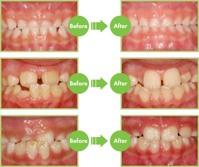 子どもの歯並び 痛くない矯正治療 かわべ歯科・キッズプラス 高津区