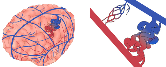 脳・脊髄動静脈奇形 - 亀田メディカルセンター｜亀田総合病院 脳血管内
