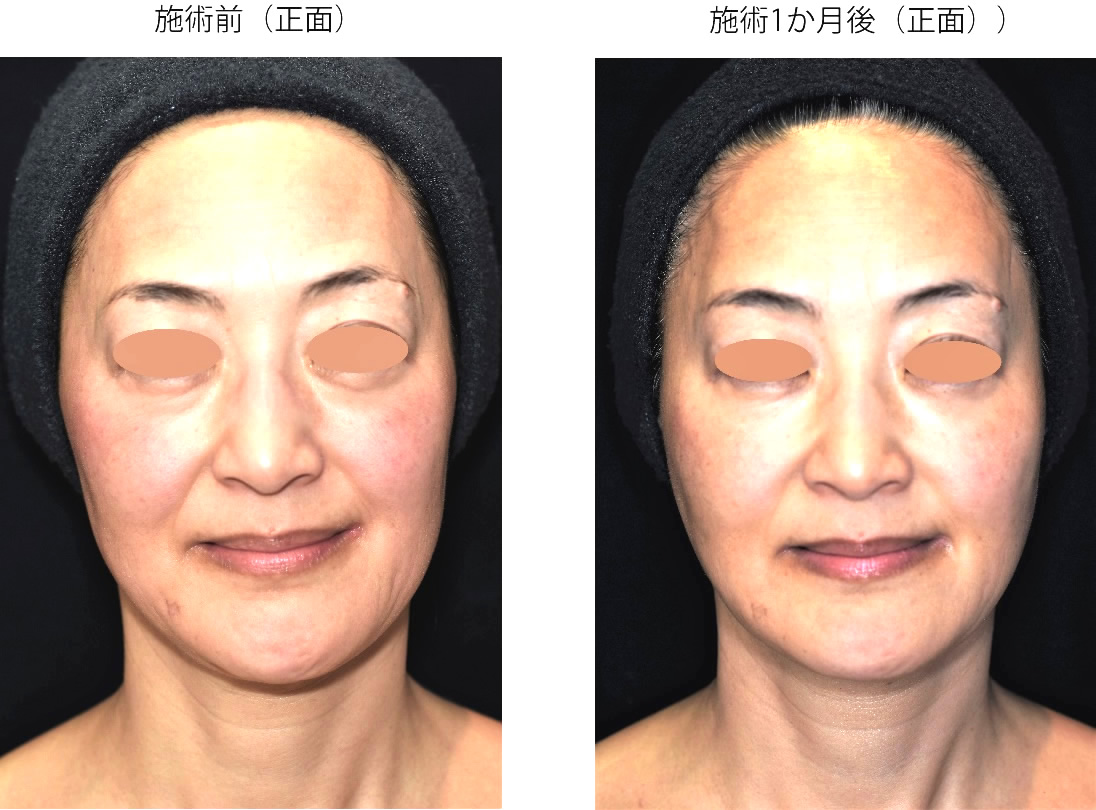 ヒアルロン酸注入（美人顔デザイン注入）：施術メニュー：ハ行｜銀座