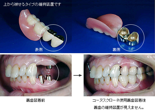 審美治療・ホワイトニング｜高松市 松崎ファミリー歯科矯正歯科