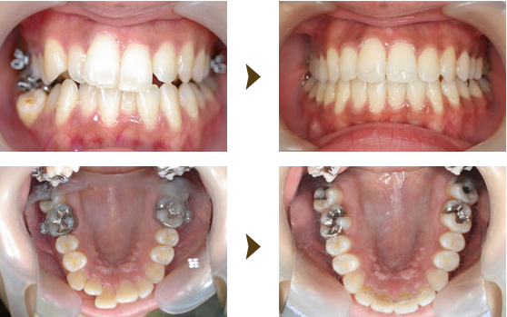 神戸 ワイヤレス矯正 クリアアライナー｜うしじま歯科・矯正歯科クリニック