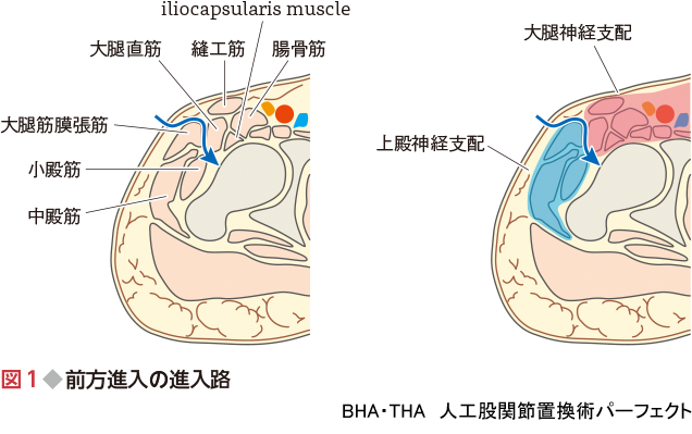 BHA・THA 人工股関節置換術パーフェクト〜人工骨頭置換術・人工股関節