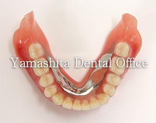 総入れ歯の金属床の設計 | 大阪精密入れ歯治療室