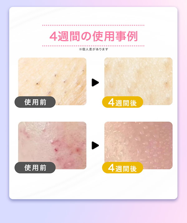 Qoo10] JOVS 脱毛器 脱毛美顔器 VIO対応 JOVS