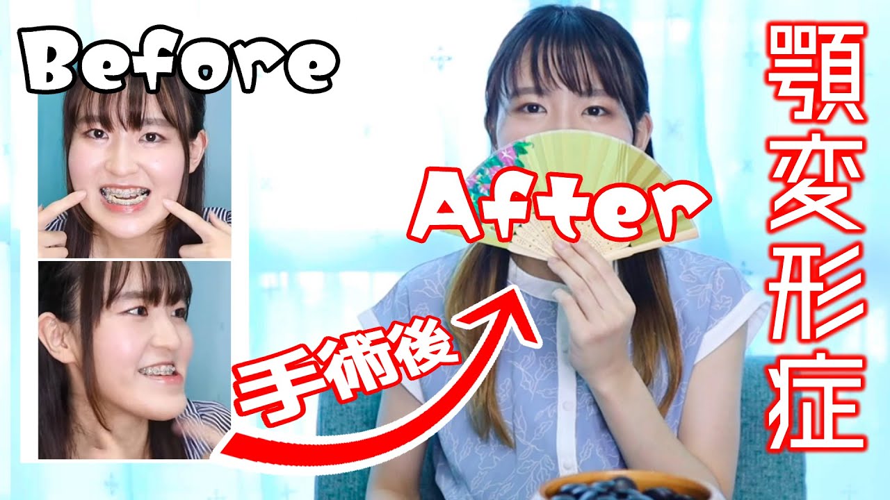 術後のお顔お見せします！】顎変形症手術ビフォーアフター【動画投稿