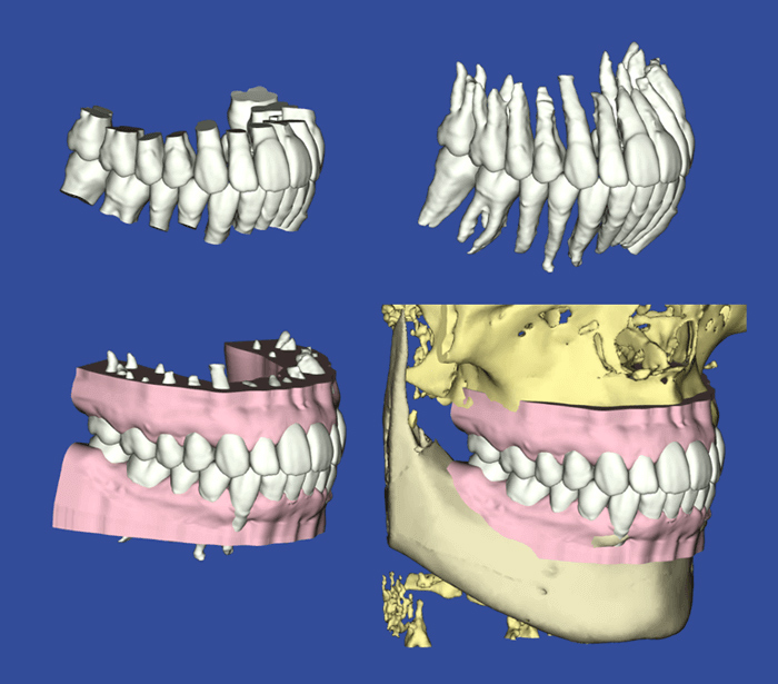 デジタル矯正システムを用いた治療方法 | 【公式】日本橋はやし矯正歯科