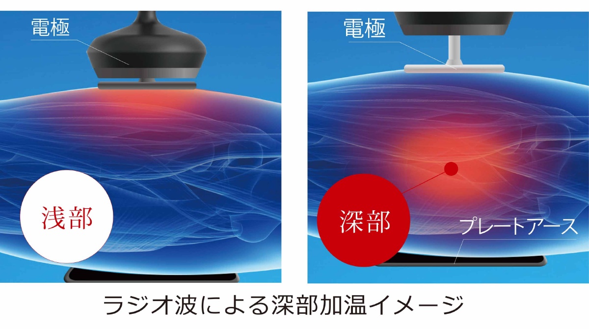 PHYSIO RADIO STIM（フィジオラジオスティム）｜ラスティア