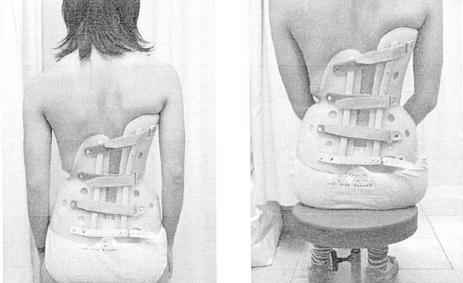 側湾症 【大塚整体治療院】 そくわん症 側わん症 側弯症