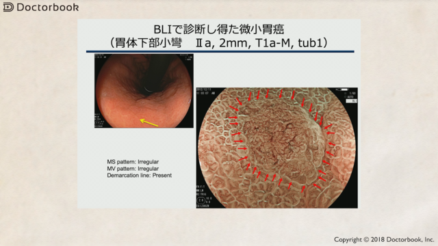 医師出演】NBI・BLIによる胃がんの拡大内視鏡診断とは？ | Doctorbook