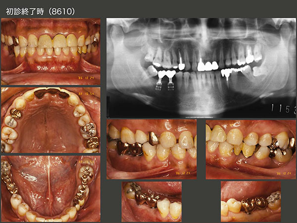 インプラント | 診療科目 | 古屋歯科クリニック